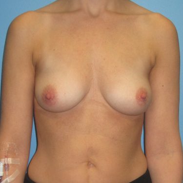 Breast Augmentation Before Patient 18