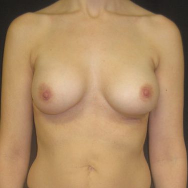 Breast Augmentation After Patient 18