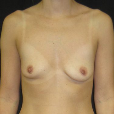 Breast Augmentation Before Patient 17