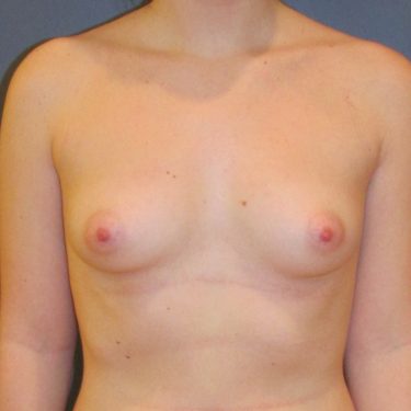 Breast Augmentation Before Patient 16
