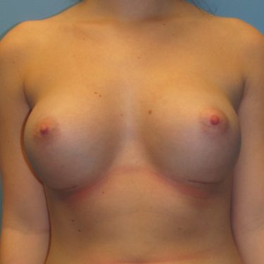 Breast Augmentation After Patient 16