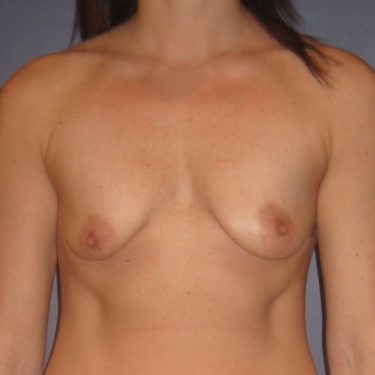 Breast Augmentation with Lift Before Patient 11