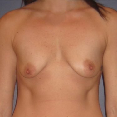 Breast Lift Before Patient 19