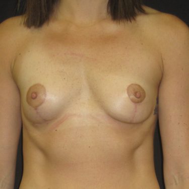 Breast Lift After Patient 19