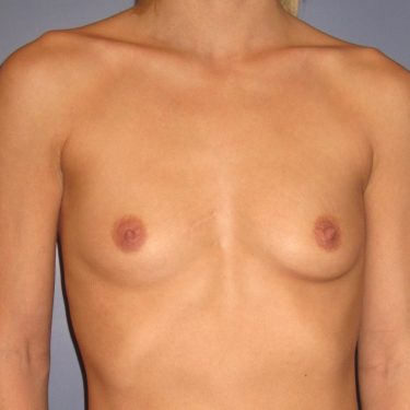 Breast Augmentation Before Patient 14