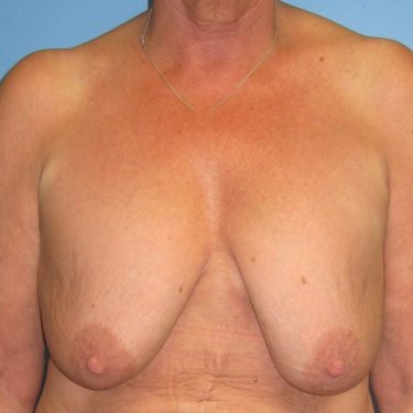 Breast Lift Before Patient 18