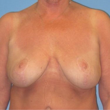 Breast Lift After Patient 18