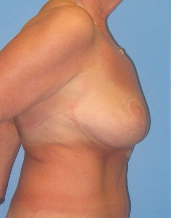 Breast Lift After Patient 3