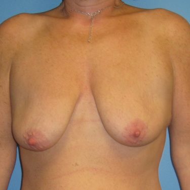Surgery After Weight Loss Before Patient 26