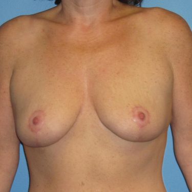 Surgery After Weight Loss After Patient 26