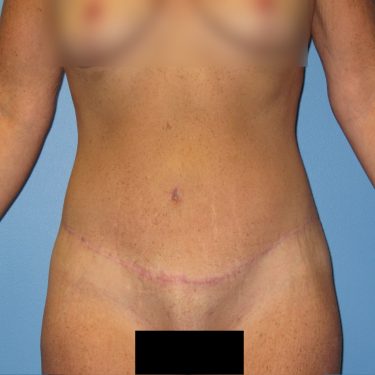 Surgery After Weight Loss After Patient 25