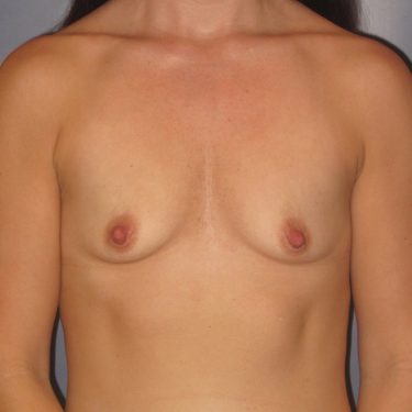 Breast Augmentation Before Patient 8