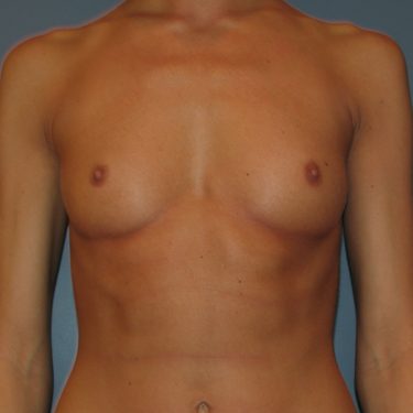 Breast Augmentation Before Patient 13