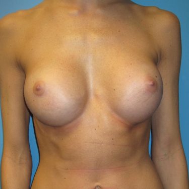Breast Augmentation After Patient 13