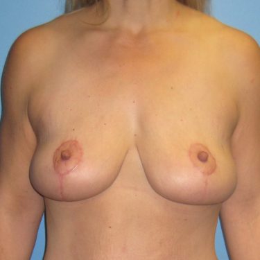 Surgery After Weight Loss After Patient 24