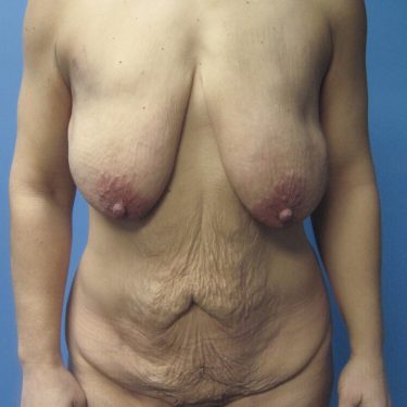 Surgery After Weight Loss Before Patient 23