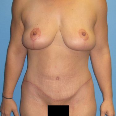 Surgery After Weight Loss After Patient 23