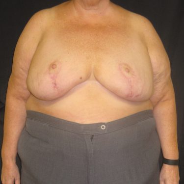 Breast Reduction After Patient 14
