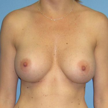 Breast Augmentation After Patient 7