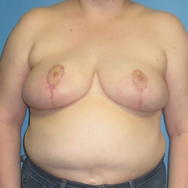 Breast Reduction After Patient 13