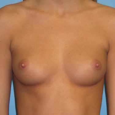 Subglandular Before Patient 13