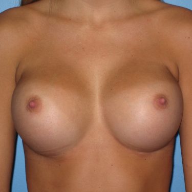 Subglandular After Patient 13