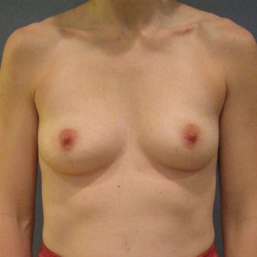 Pectus deformity Before Patient 7