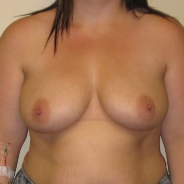 Subglandular Before Patient 12