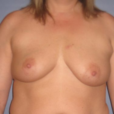 Breast Lift Before Patient 15