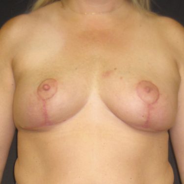 Breast Lift After Patient 15
