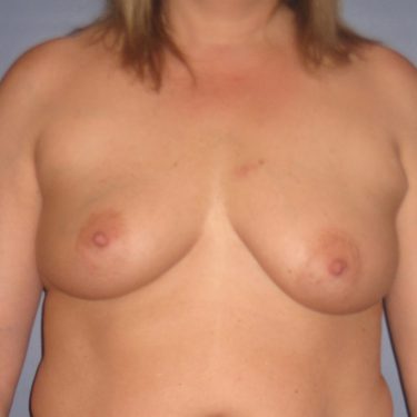 Breast Augmentation & Lift Before Patient 9