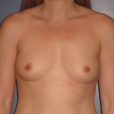 Breast Augmentation Before Patient 5