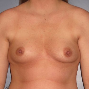 Breast Augmentation Before Patient 4