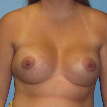 Breast Augmentation After Patient 4