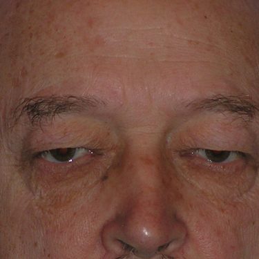 Eyes & Brow Before Patient 10