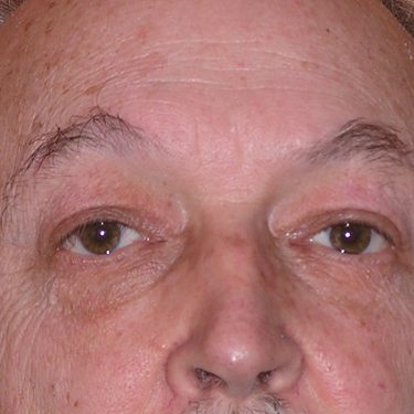 Eyes & Brow After Patient 10