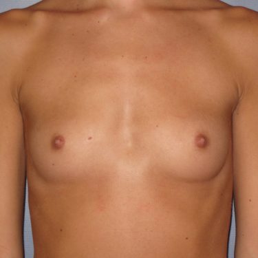 Breast Augmentation Before Patient 3