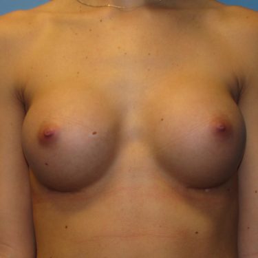 Breast Augmentation After Patient 3