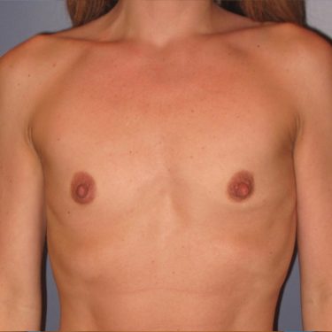 Breast Augmentation Before Patient 2