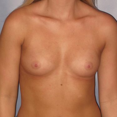 Breast Augmentation Before Patient 1