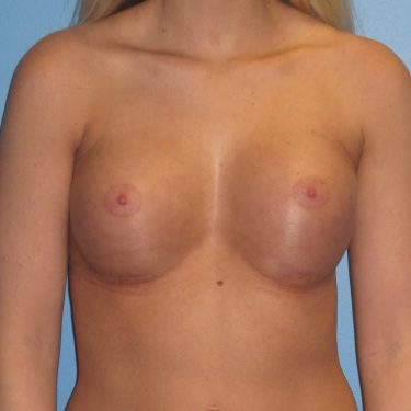 Breast Augmentation After Patient 1