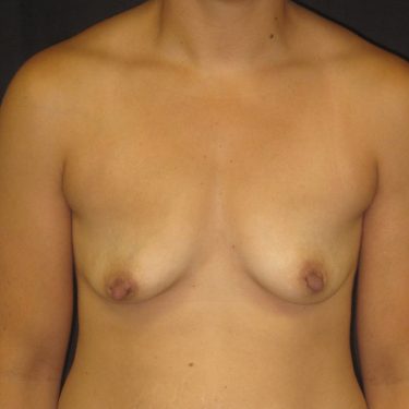 Breast Augmentation Before Patient 30
