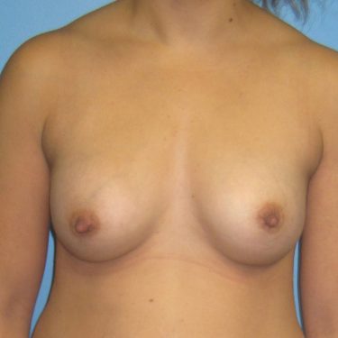 Breast Augmentation After Patient 30