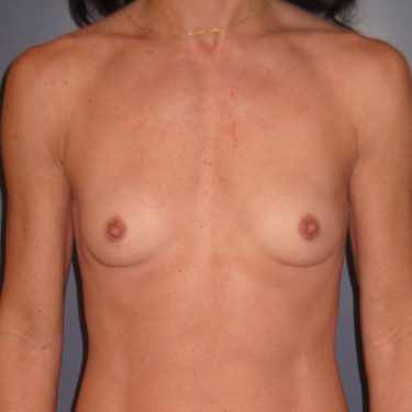 Breast Augmentation Before Patient 29