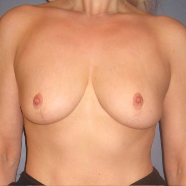 Breast Augmentation Before Patient 28