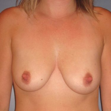 Breast Lift Before Patient 14