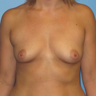 Dual-plane technique Before Patient 21