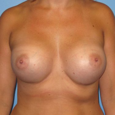 Dual-plane technique After Patient 21