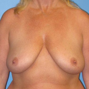 Breast Lift Before Patient 13