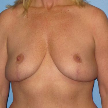 Breast Lift After Patient 13